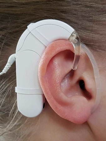 Fijador para oreja SmartEar